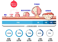 直肠癌早筛试剂盒“第一证”—足不出户而明察秋毫