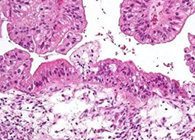 【Science速递】“沉默的杀手”卵巢癌的治疗新靶点终于被发现了